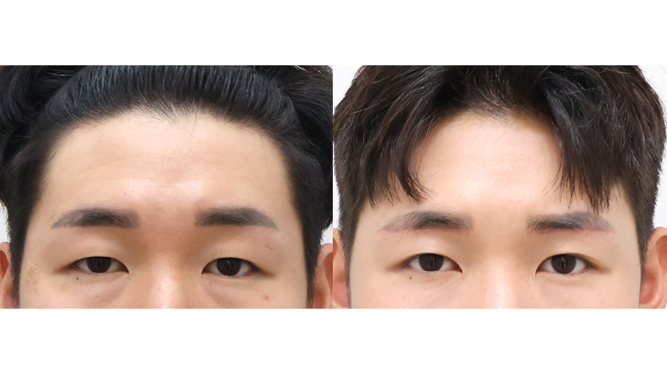 Before 8 Front