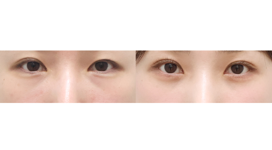 Before 7 Front