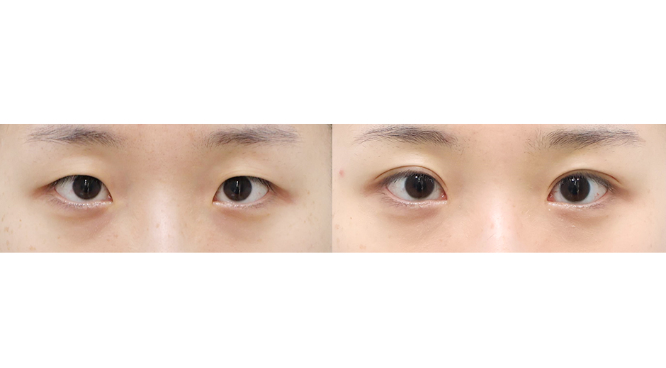 Before 4 Front