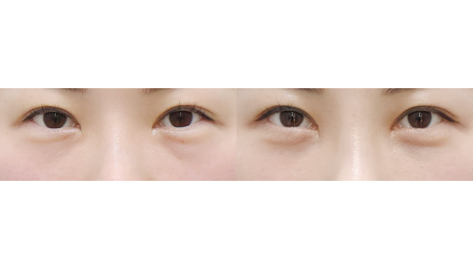 Before 1 Front