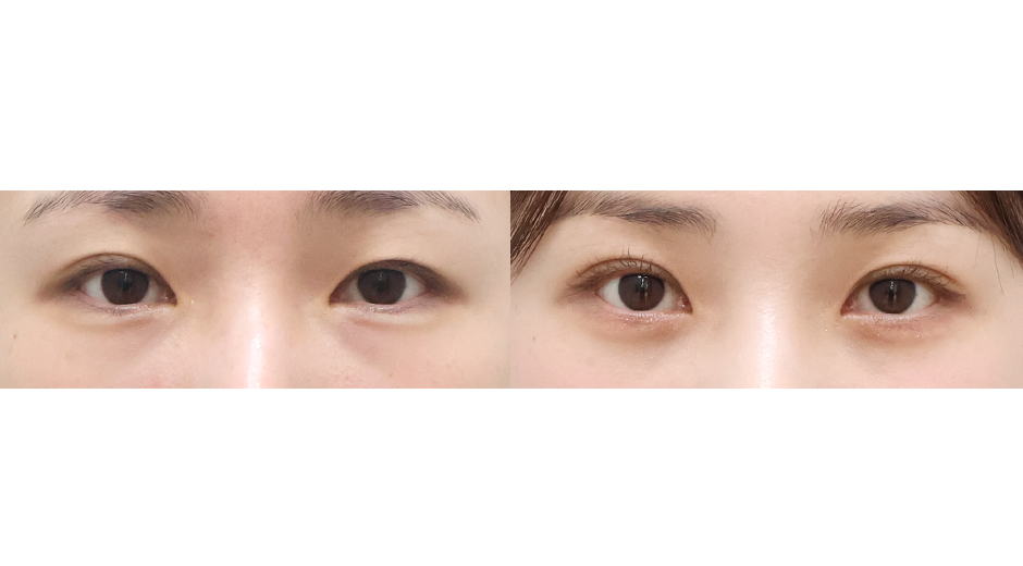 Before 6 Front